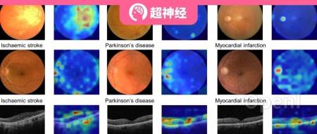 160w+ 未标注图像、3 个维度全方位评估,周玉坤等人开发 RETFound 模型,用视网膜图像预测多种系统性疾病