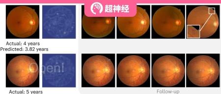 上海交大与清华联手发布DeepDR Plus,仅用眼底图像可预测5年内糖尿病视网膜病变进展