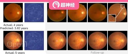 上海交大与清华联手发布 DeepDR Plus,仅用眼底图像可预测 5 年内糖尿病视网膜病变进展