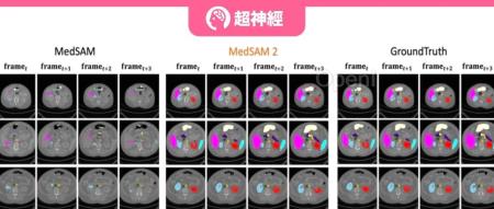 SAM 2最新应用落地!牛津大学团队发布Medical SAM 2,刷新医学图像分割SOTA榜